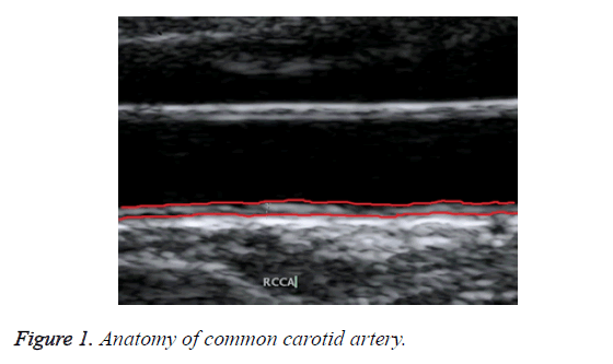 biomedres-carotid-artery