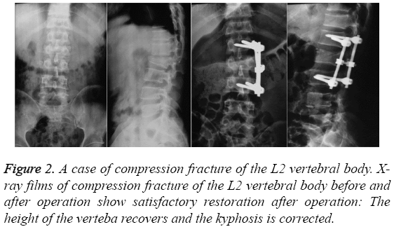 biomedres-case-compression-fracture