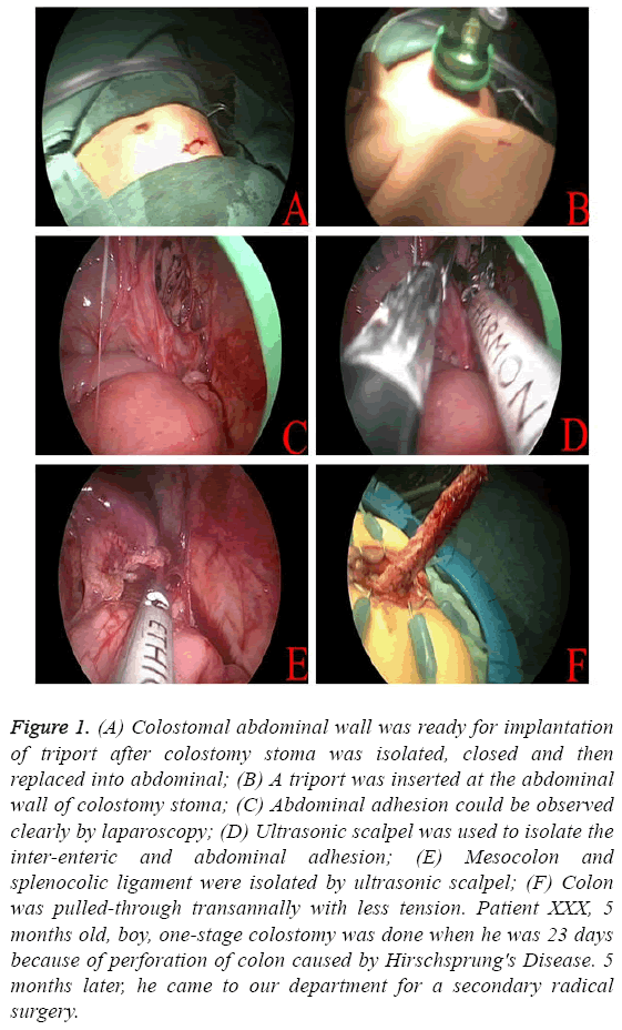 biomedres-casting-triport-colostomy