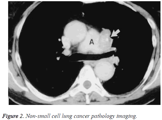 biomedres-cell-lung-cancer