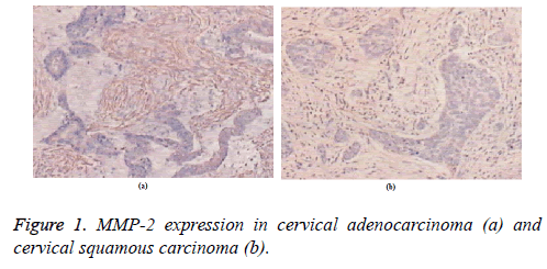 biomedres-cervical-squamous