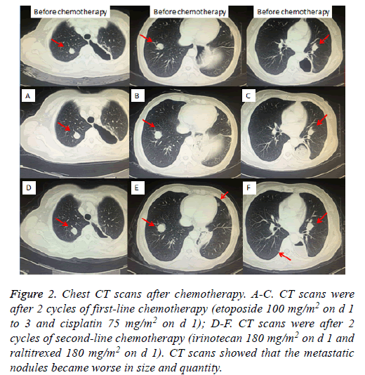 biomedres-chemotherapy-endoscopy