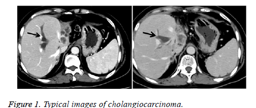 biomedres-cholangiocarcinoma