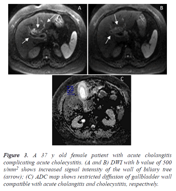 biomedres-cholangitis-cholecystitis