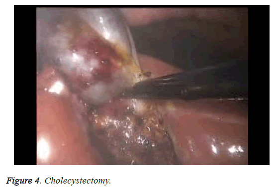 biomedres-cholecystectomy