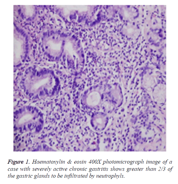 biomedres-chronic-gastritis