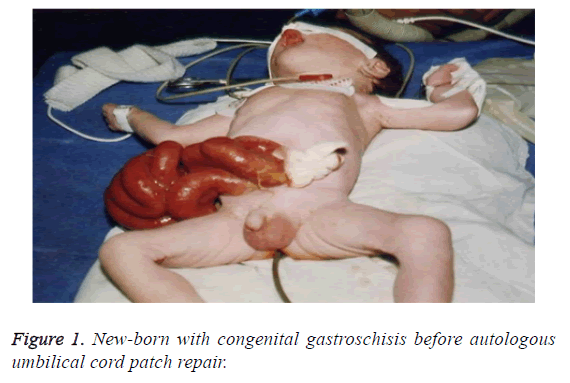 biomedres-congenital-gastroschisis