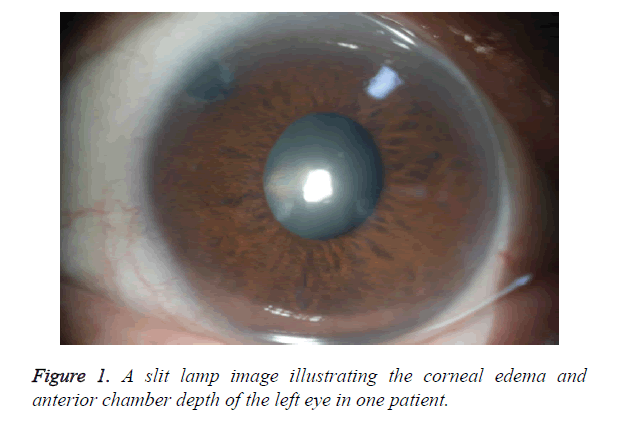 biomedres-corneal-edema