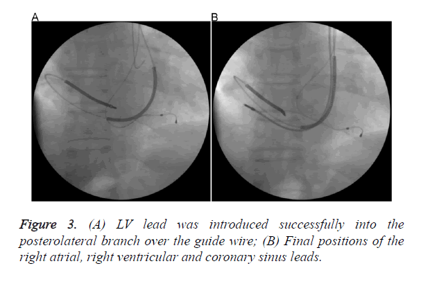 biomedres-coronary-sinus