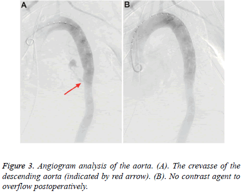 biomedres-crevasse-gastric