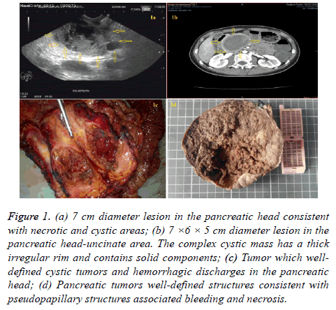 biomedres-cystic-mass