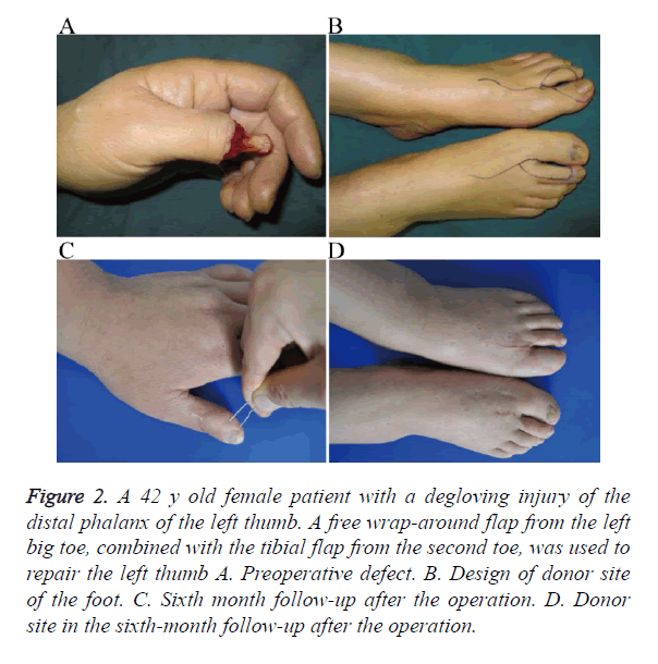 biomedres-degloving-injury