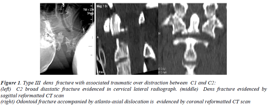 biomedres-dens-fracture