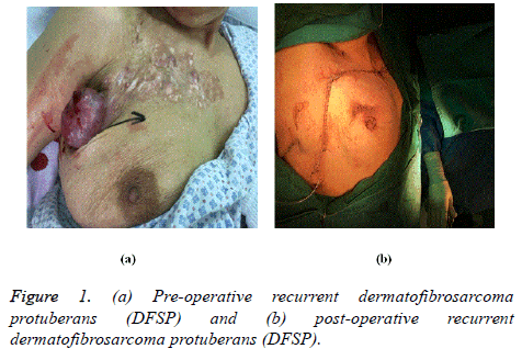 biomedres-dermatofibrosarcoma