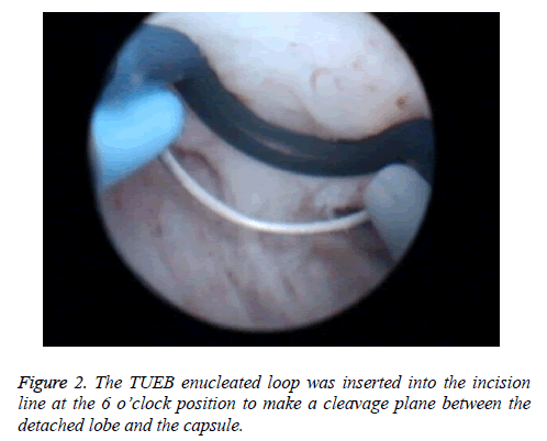 biomedres-detached-lobe