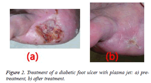 biomedres-diabetic-foot