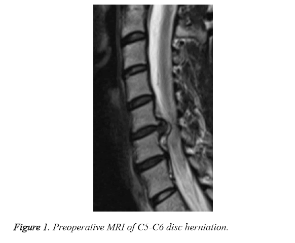 biomedres-disc-herniation