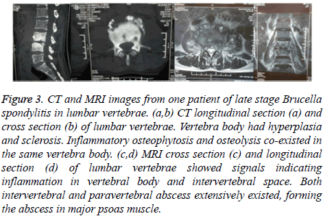 biomedres-disease-lumbar