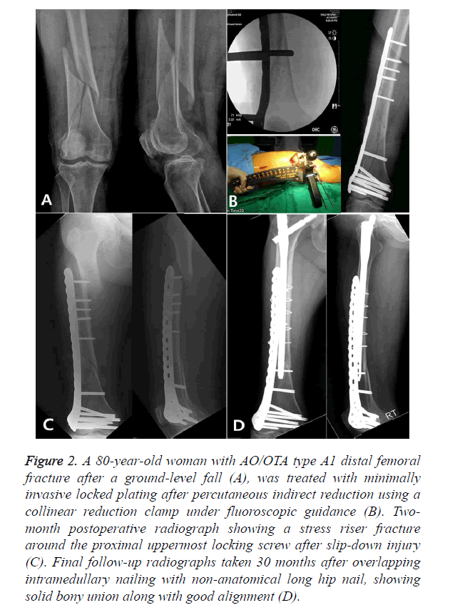 biomedres-distal-femoral