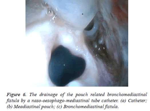 biomedres-drainage-tube