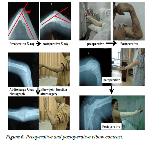 biomedres-elbow-contrast