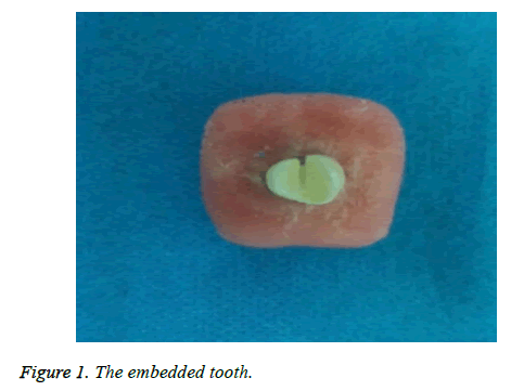 biomedres-embedded-tooth