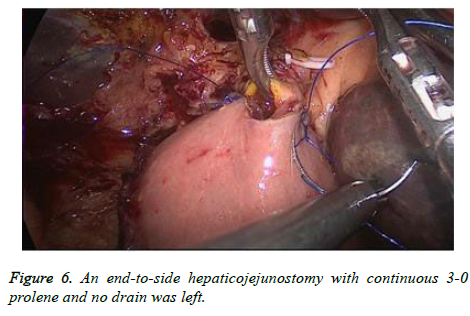 biomedres-end-side-hepaticojejunostomy