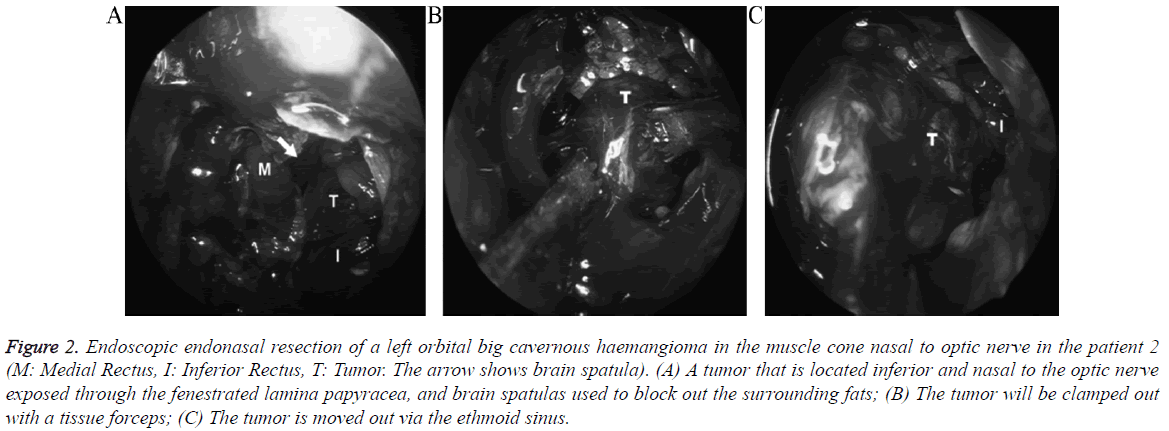 biomedres-endonasal-resection