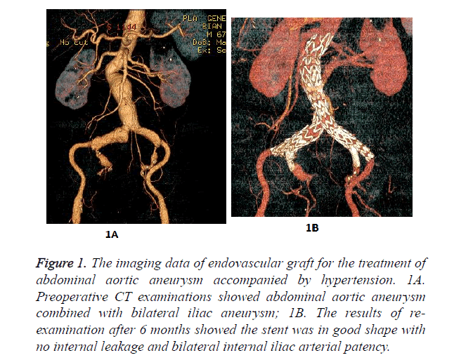 biomedres-endovascular-graft