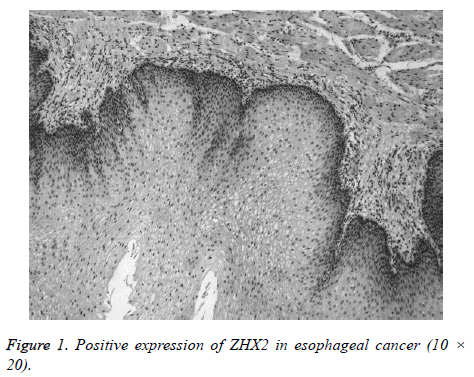 biomedres-esophageal-cancer