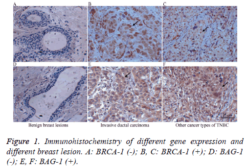 biomedres-expression-breast-lesion