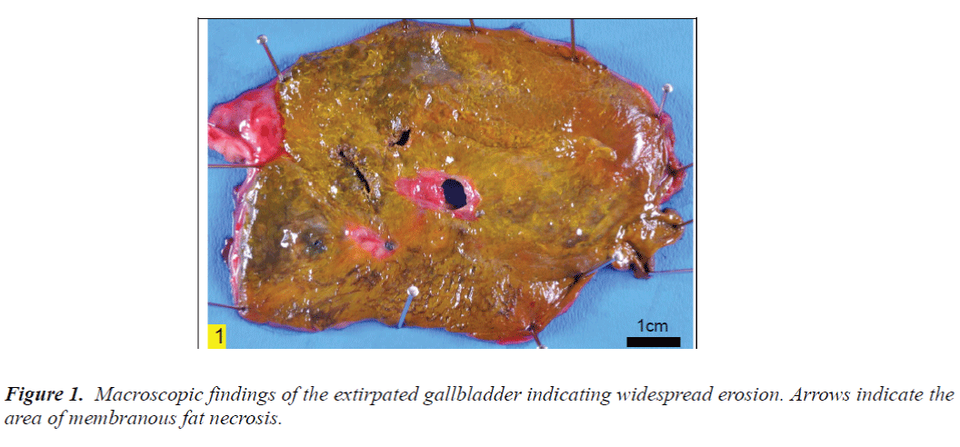 biomedres-extirpated-gallbladder-indicating