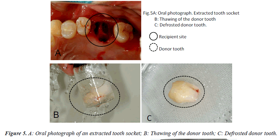 biomedres-extracted-tooth-socket