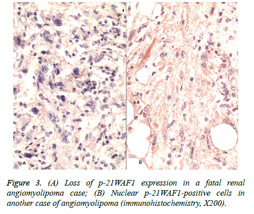 biomedres-fatal-renal-cells