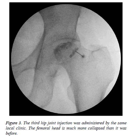 biomedres-femoral-head