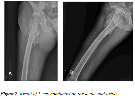 biomedres-femur-pelvis