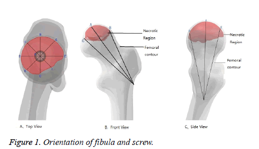 biomedres-fibula-screw