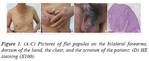 biomedres-flat-papules