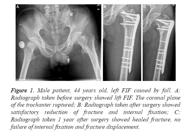 biomedres-fracture-displacement