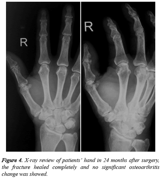 biomedres-fracture-healed-completely