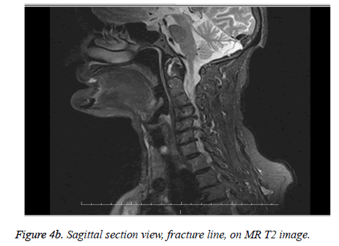 biomedres-fracture-line