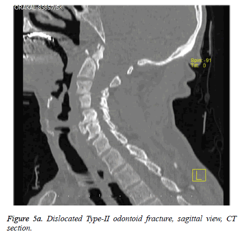 biomedres-fracture-sagittal