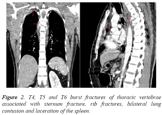 biomedres-fractures-thoracic-vertebrae