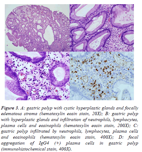 biomedres-gastric-polyp