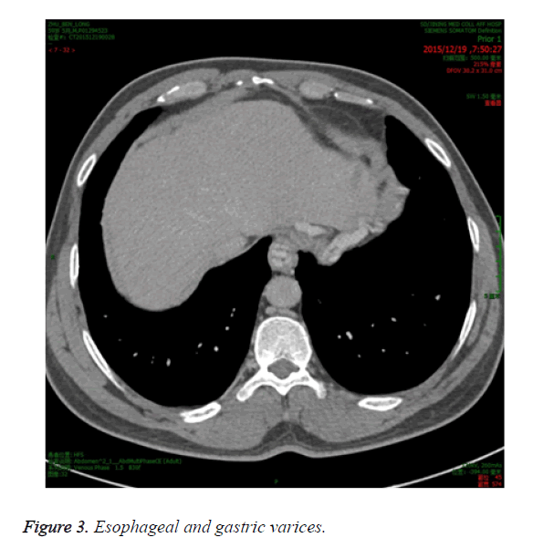 biomedres-gastric-varices