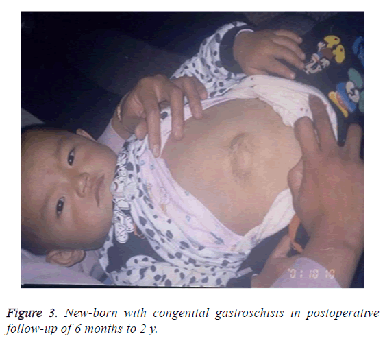 biomedres-gastroschisis-postoperative