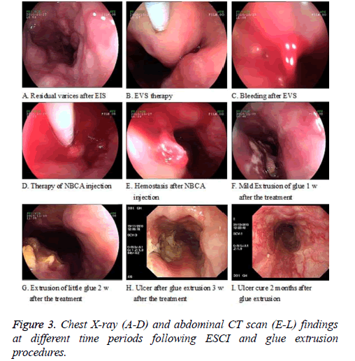 biomedres-glue-extrusion