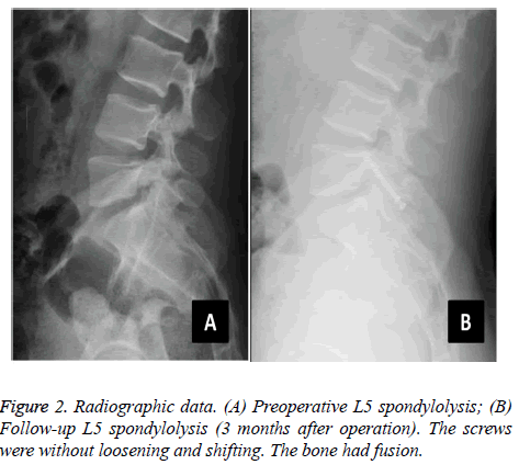 biomedres-heart-spondylolysis