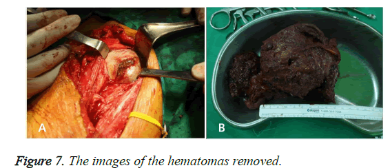 biomedres-hematomas-removed