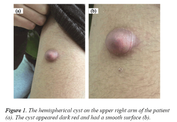 biomedres-hemispherical-cyst